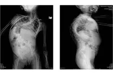 Boyun Kemiği Özellikleri ve Faydaları Nelerdir?