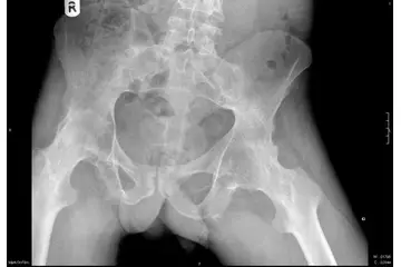 Kemik İliği Ödemi Belirtileri ve Tedavisi